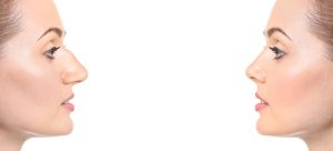 xrhinoplastie-tunisie_0.jpg.pagespeed.ic.6g9l4ryyep