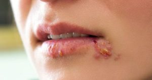herpes
