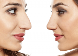 rhinoplastie