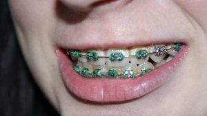 tooth-366335__340
