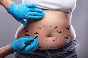 Abdominoplastie
