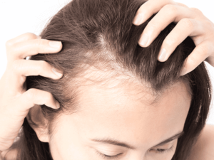 alopecie