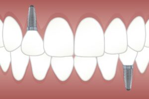 teeth-g7195f8e4f_1280