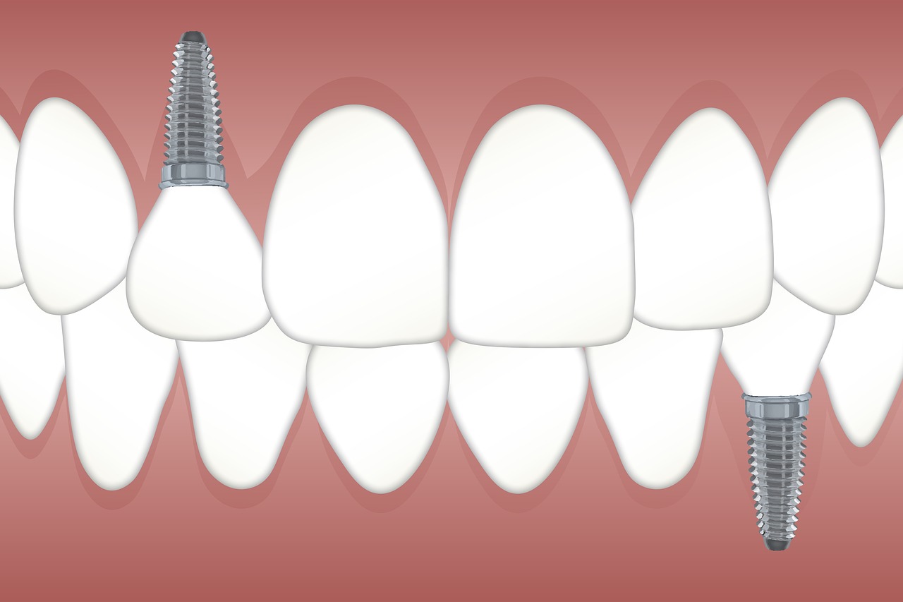 teeth-g7195f8e4f_1280