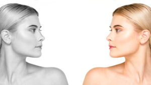 rhinoplastie