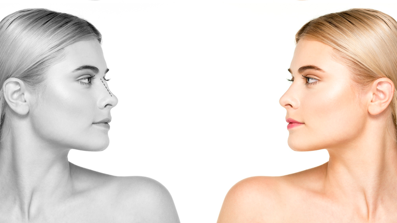 rhinoplastie