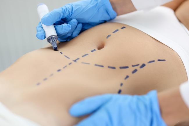 abdominoplastie-chirurgie-esthetique